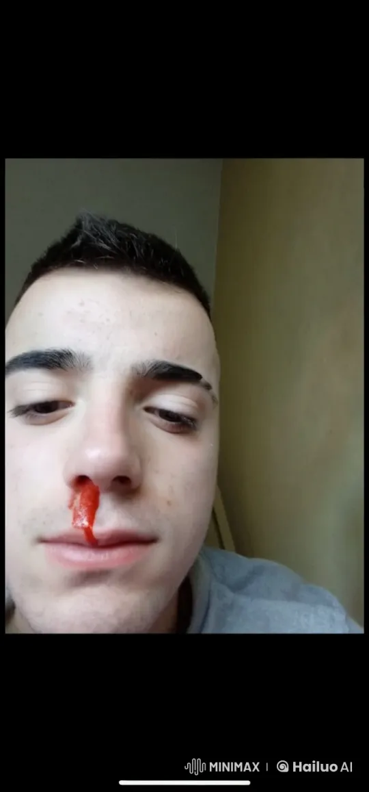 Subtle Bleeding to Sudden Head Explosion – AI Generated Video | Hailuo AI