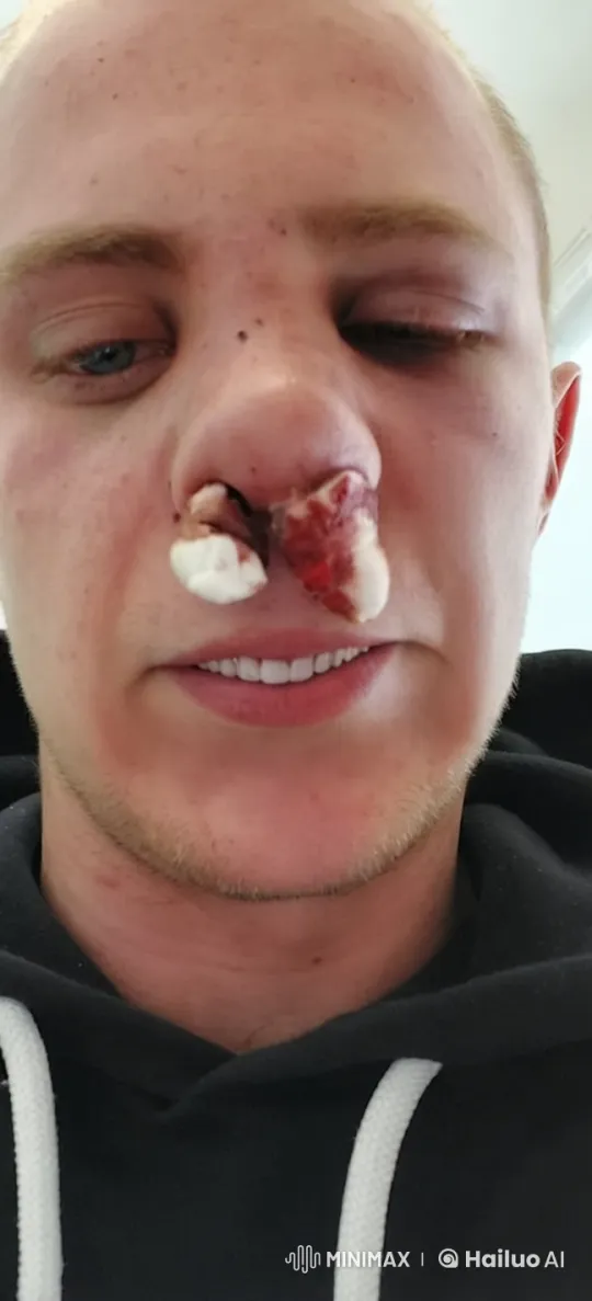 Live2D Animation of Individual Injecting Cheek – AI Generated Video | Hailuo AI