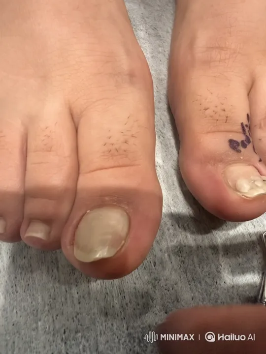Clinical Close-Up of Damaged Toenails with Ortonyil – AI Generated Video | Hailuo AI