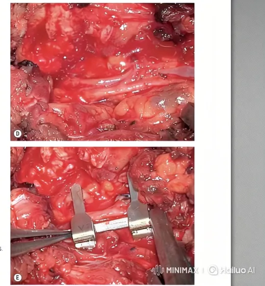 Surgical Clamping of Internal Structure – AI Generated Video | Hailuo AI
