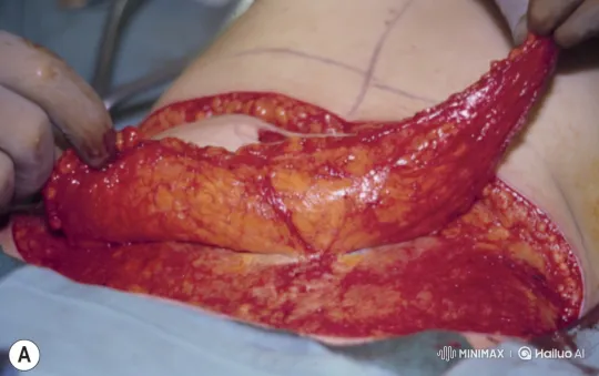 Surgical Procedure: Close-up of Dissected Tissue Manipulation – AI Generated Video | Hailuo AI