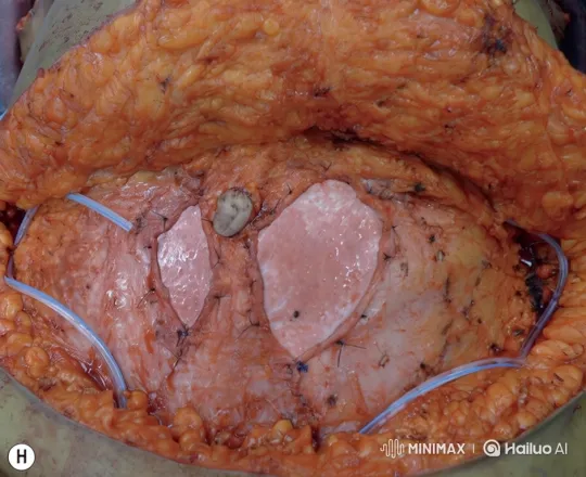 Surgical Implantation and Assessment of Pink Patches – AI Generated Video | Hailuo AI