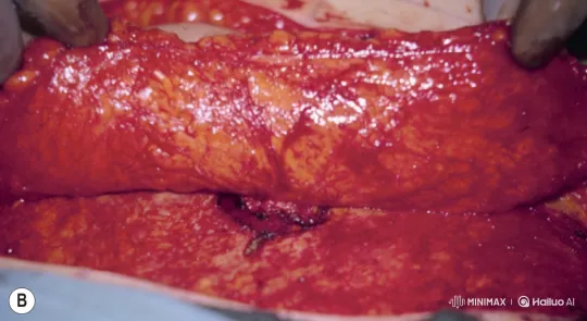 Microsurgical Procedure: Precision Cutting and Dissection – AI Generated Video | Hailuo AI